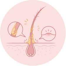 Follicle blockage and inflammation associated with glue