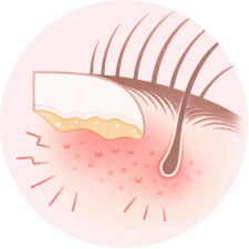 Irritation or allergic contact dermatitis from certain adhesives